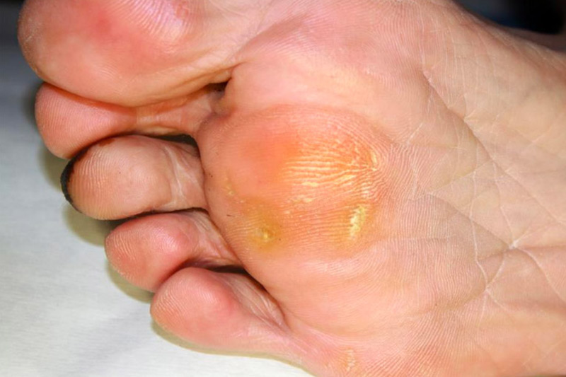 about-corns-and-calluses